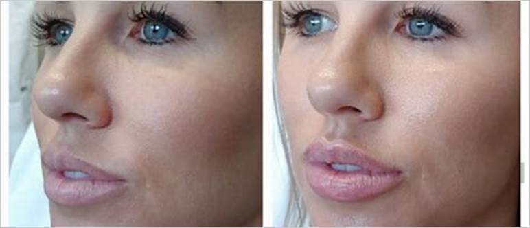 Long lasting lip injections
